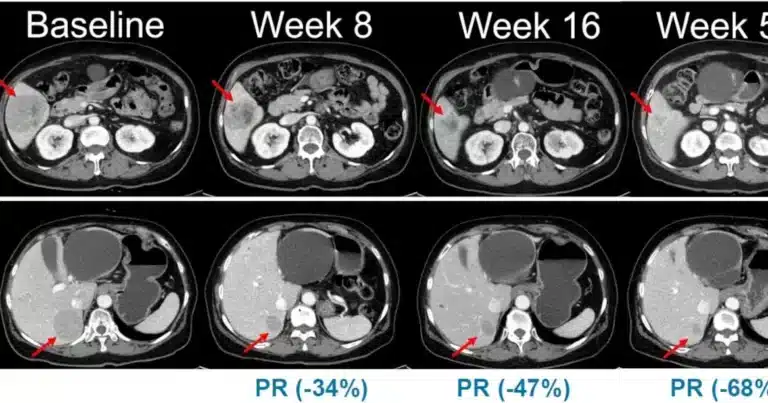 Hanmi Pharm Starts Phase 2 Dosing for NRAS Melanoma Drug